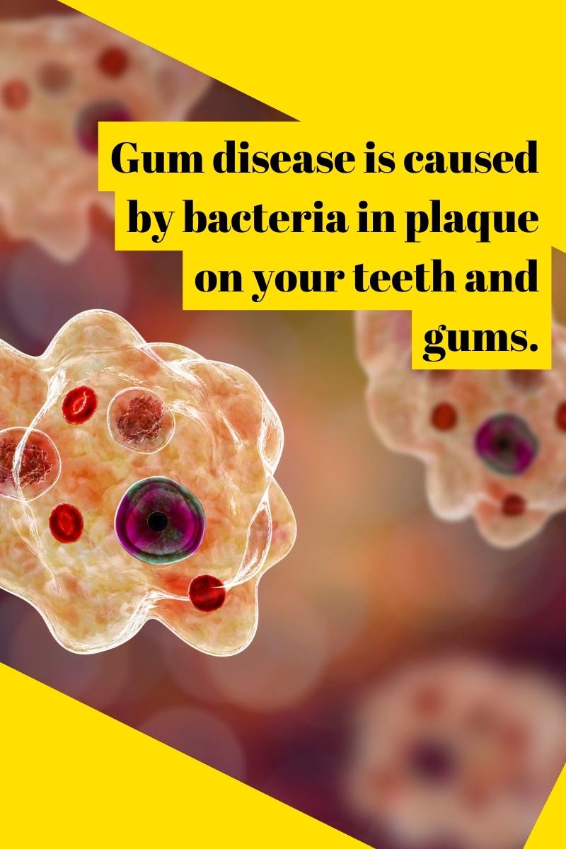 Gum disease is caused by bacteria in plaque on your teeth and gums.